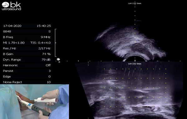 Urology AMD SureFire for BK Medical Biplanare Sonden